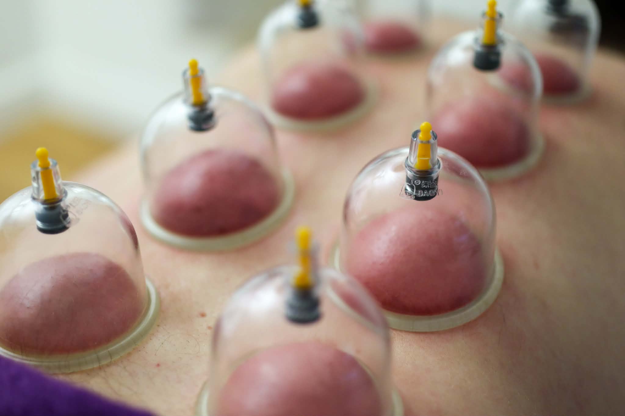 Cupping Therapy Setup