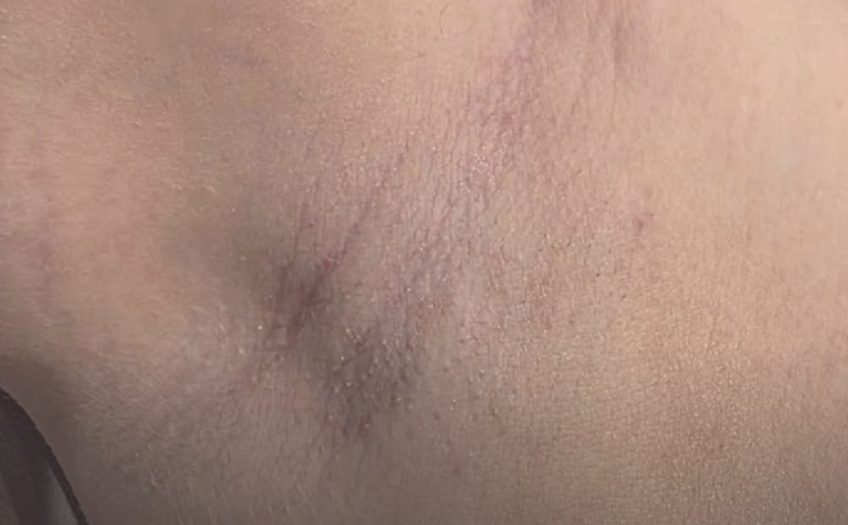 After Laser Hair Removal